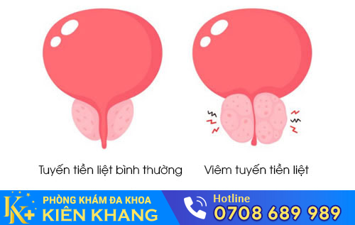 Viêm tuyến tiền liệt