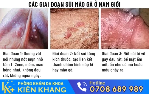 cac giai doan sui mao ga o nam gioi